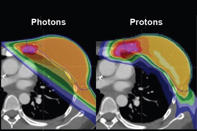 Treating Breast Cancer With Proton Therapy Iba Campus